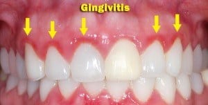 How to get rid of gingivitis