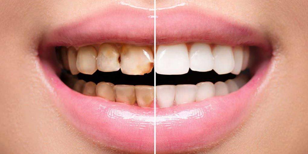 What is the best teeth whitening product to use at home