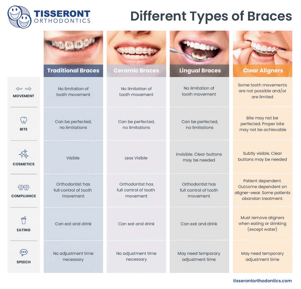 Different Types of Braces
