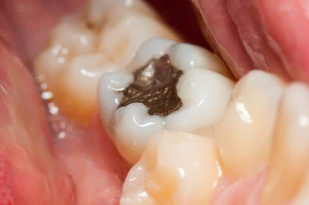 Dental filling causes teeth sensitivity